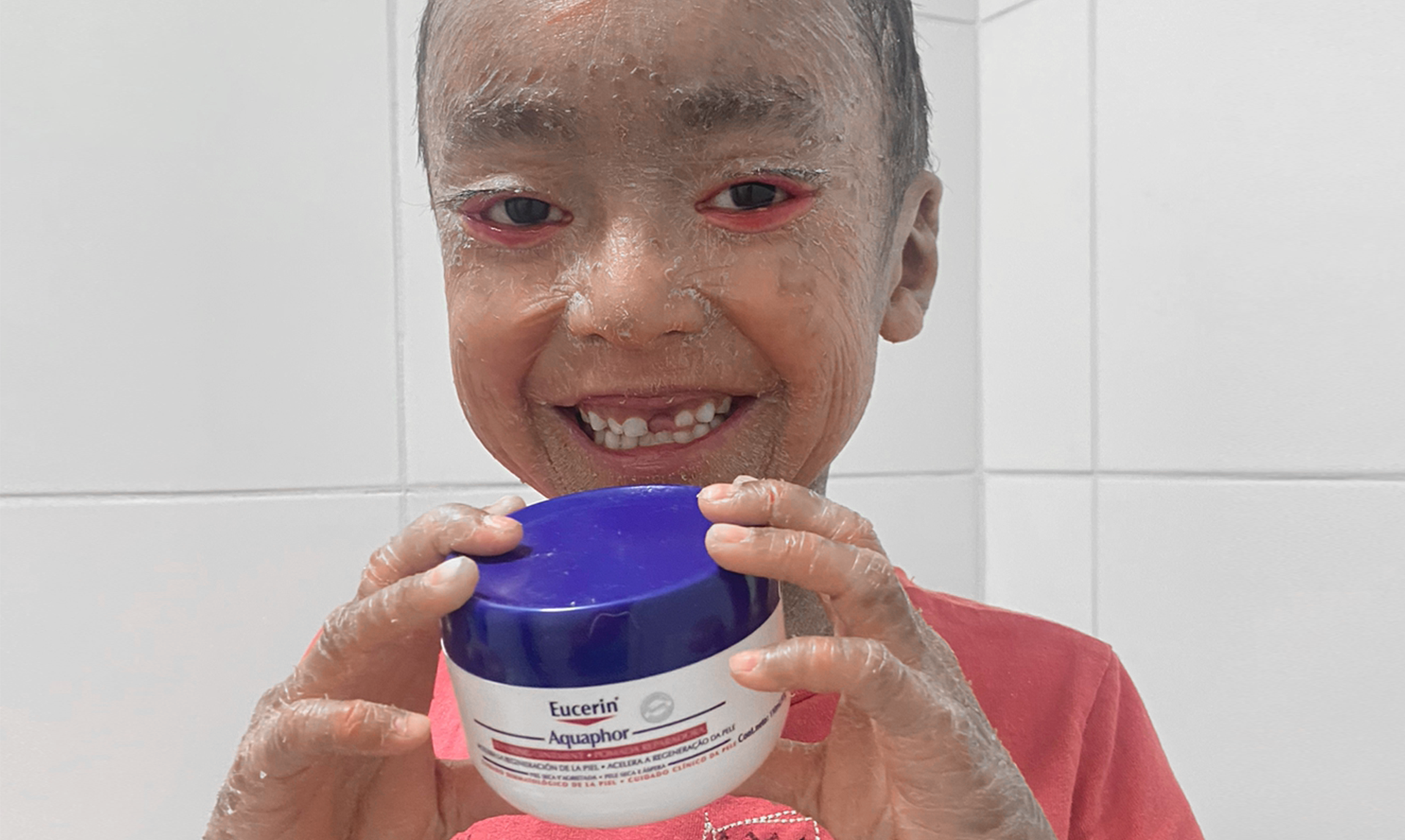 ENCOUNTER / PSORIASIS Project in Germany 