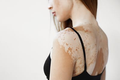 Vitiligo am Rücken