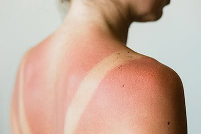 Schulter einer Frau mit Sonnenbrand