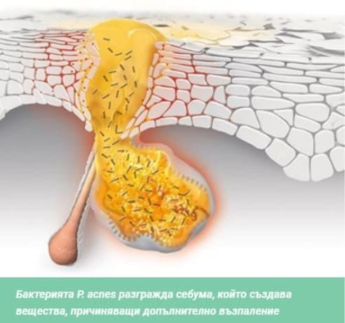 бактерията p.acnes