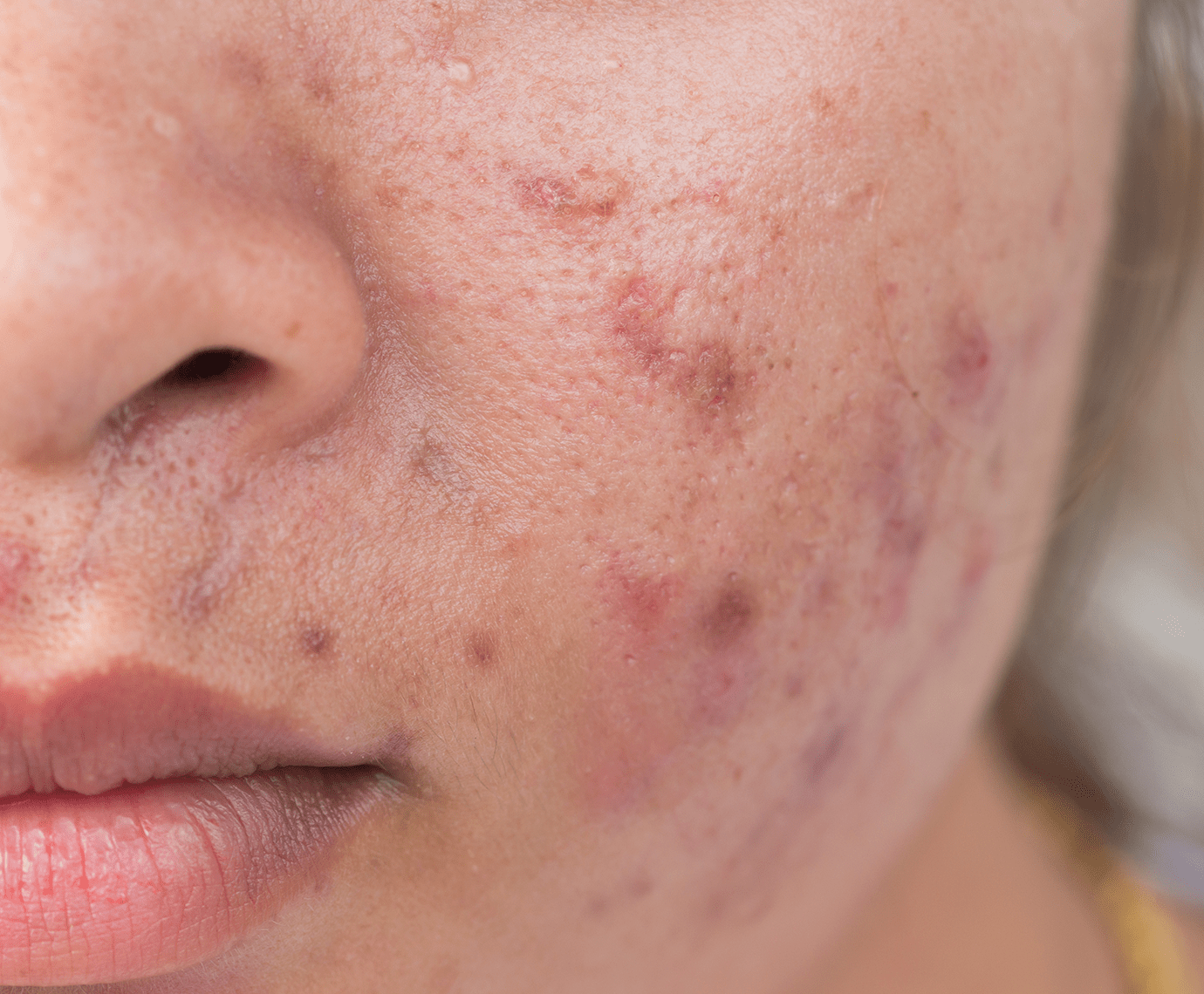 close up image of pimple marks