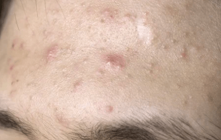 close up photograph of forehead acne