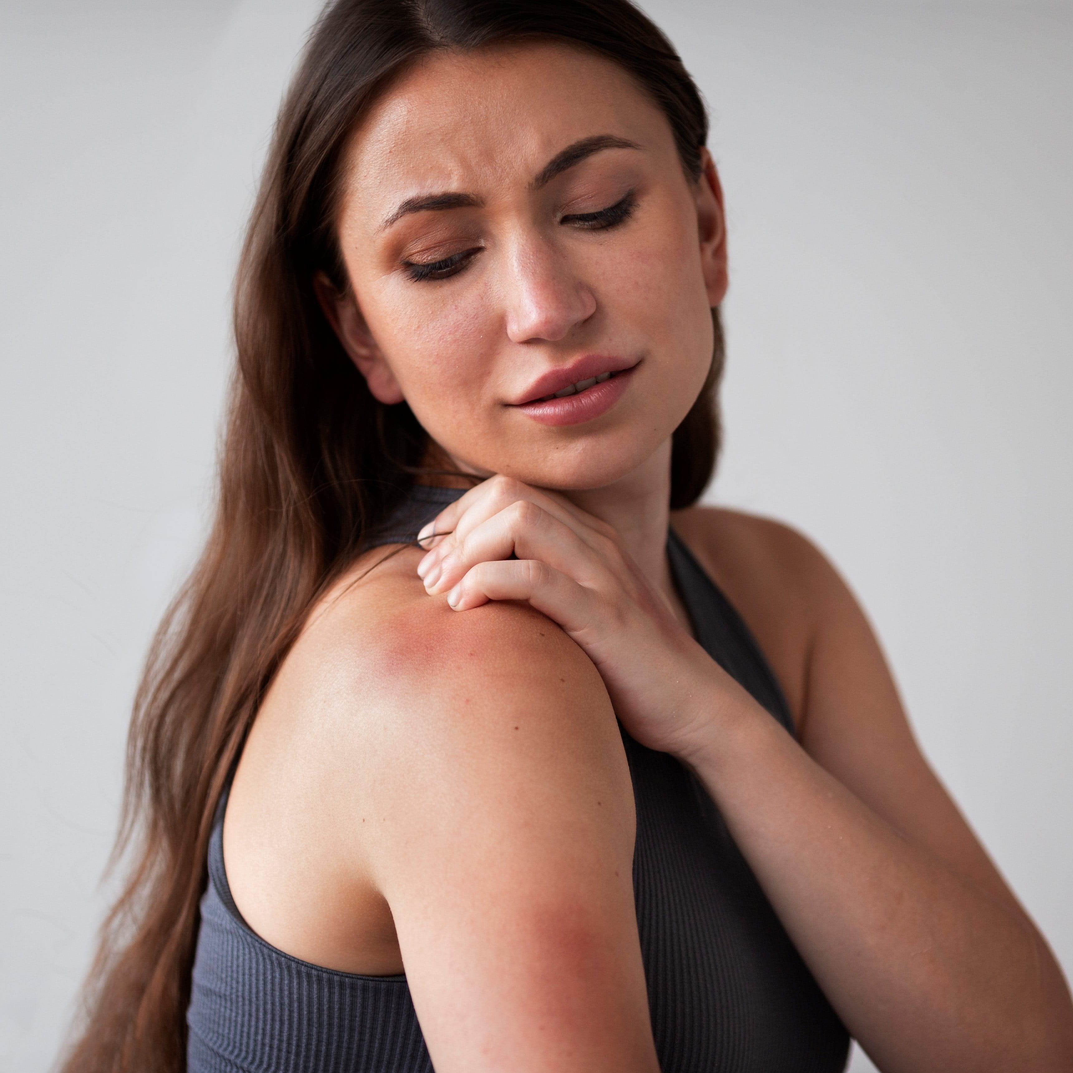 Woman suffering from sunburn