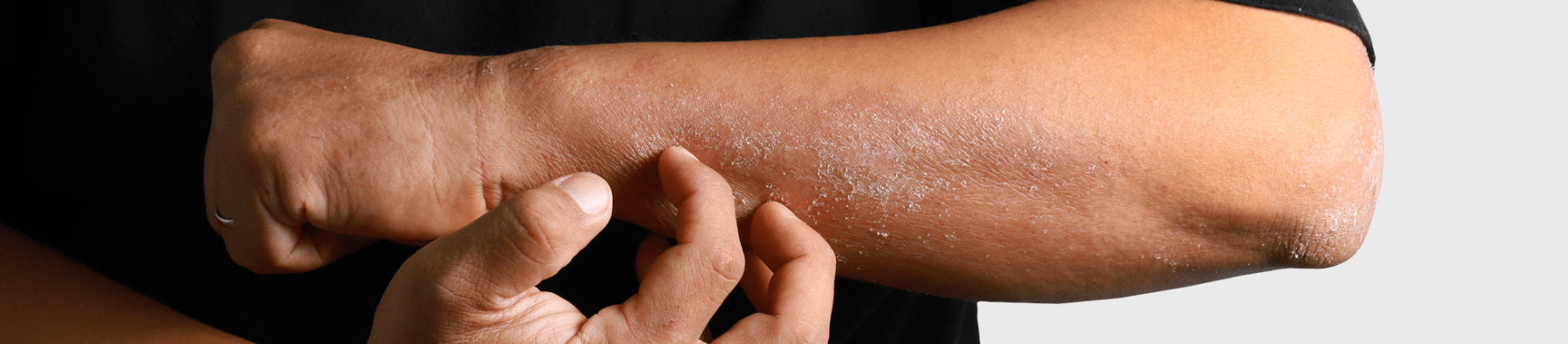 Contact dermatitis on hands