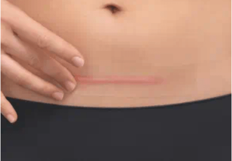 Close up of woman’s caesarean scar
