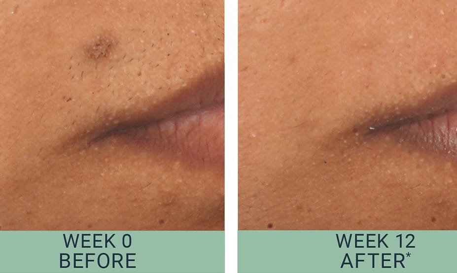 DermoPurifyer reducing post-acne marks