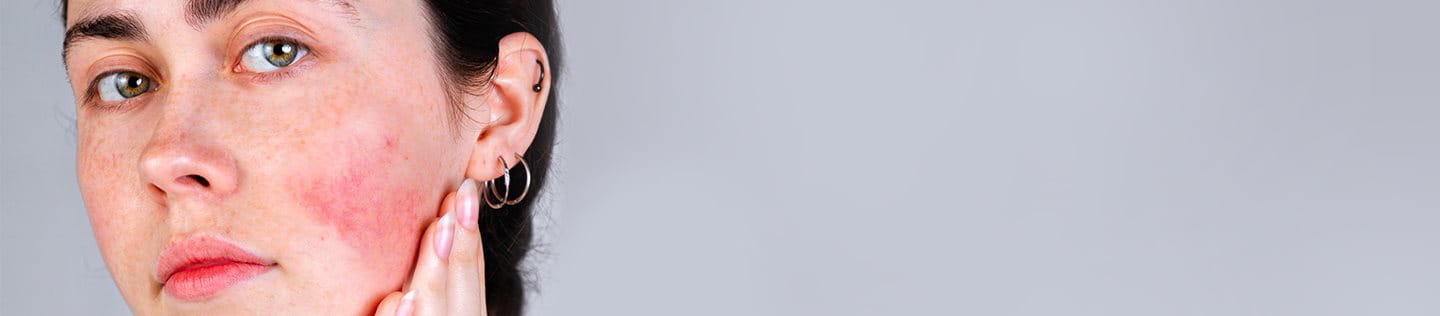 macchie rosse sulla pelle senza prurito