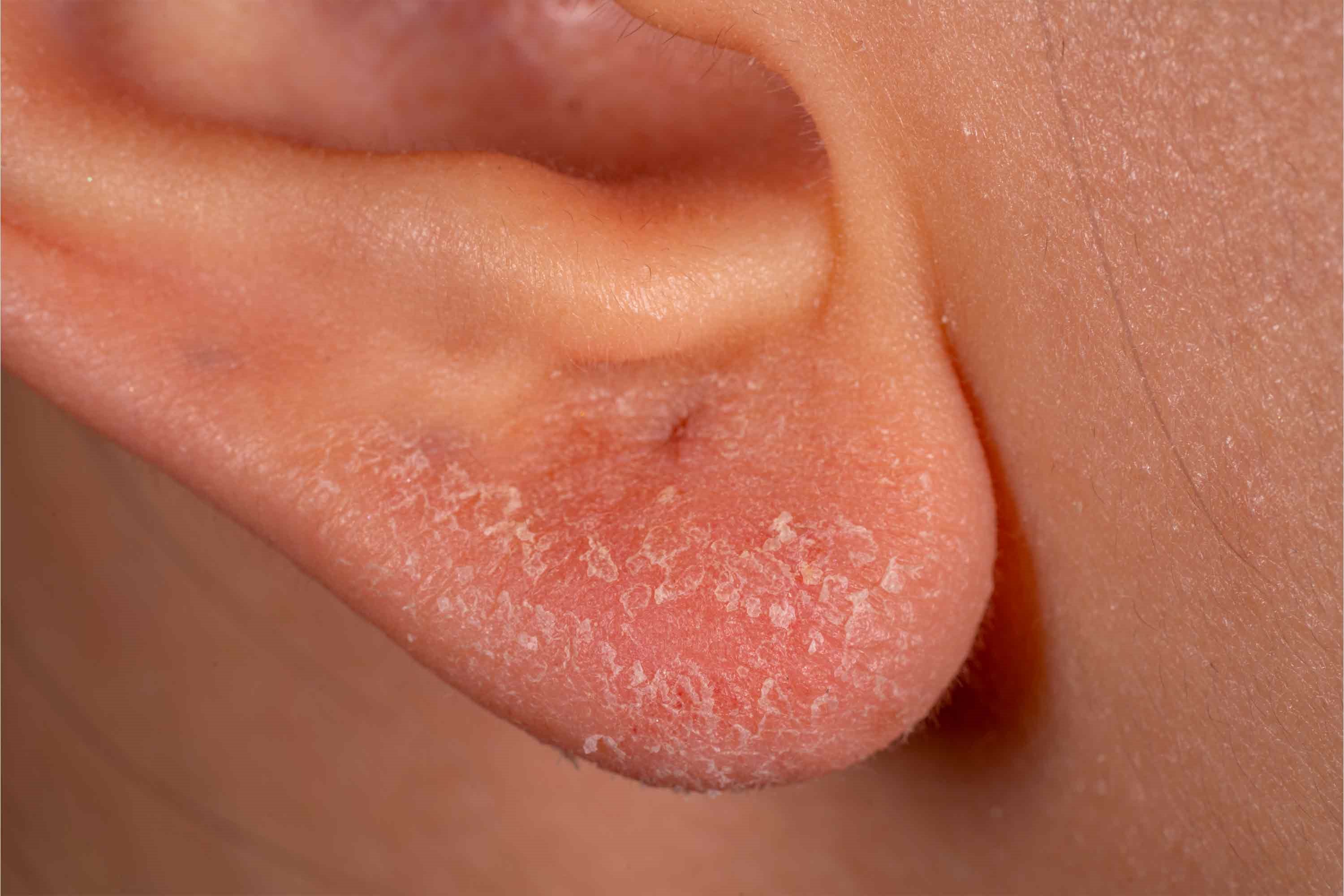 orecchie screpolate per dermatite orecchio provoca prurito