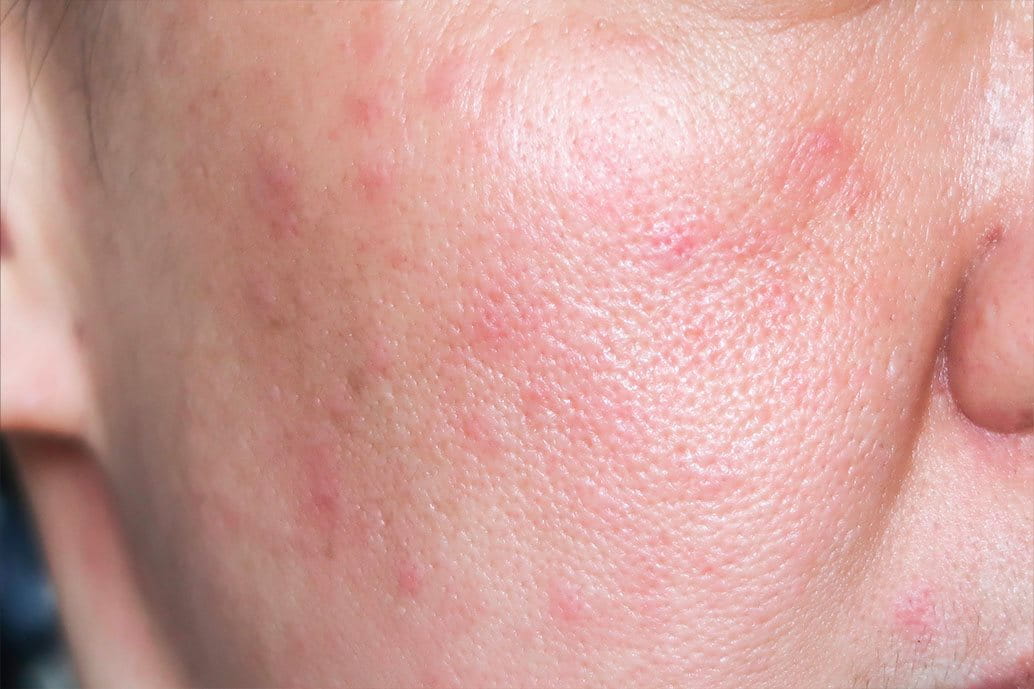 immagine di dermatite da stress sul viso