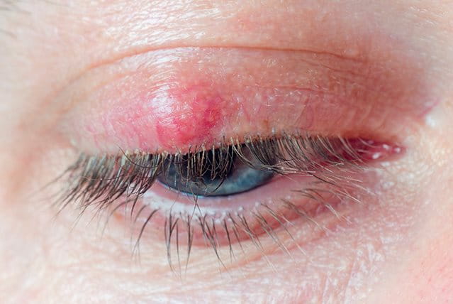 eczema sugli occhi