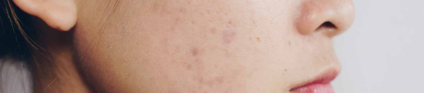 schiacciare i brufoli