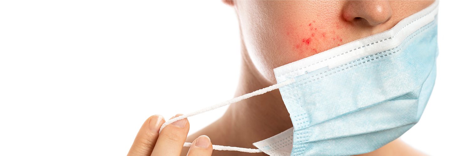 Maskne