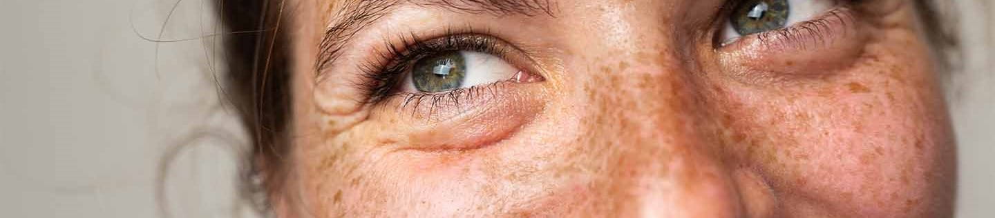 lentiggini e tipi di carnagione