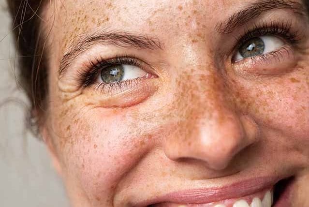 lentiggini e tipi di carnagione