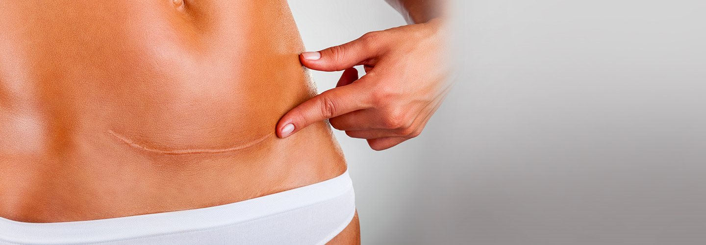 foto della cicatrice cheloide