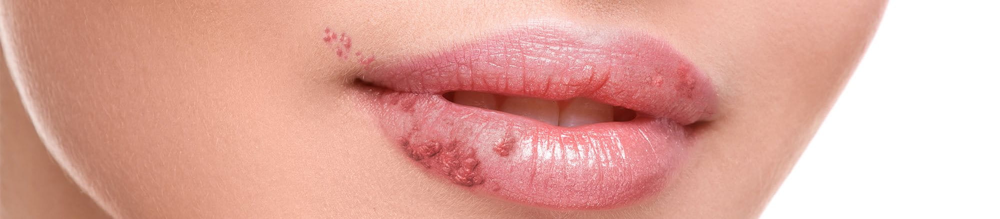 herpes sulle labbra