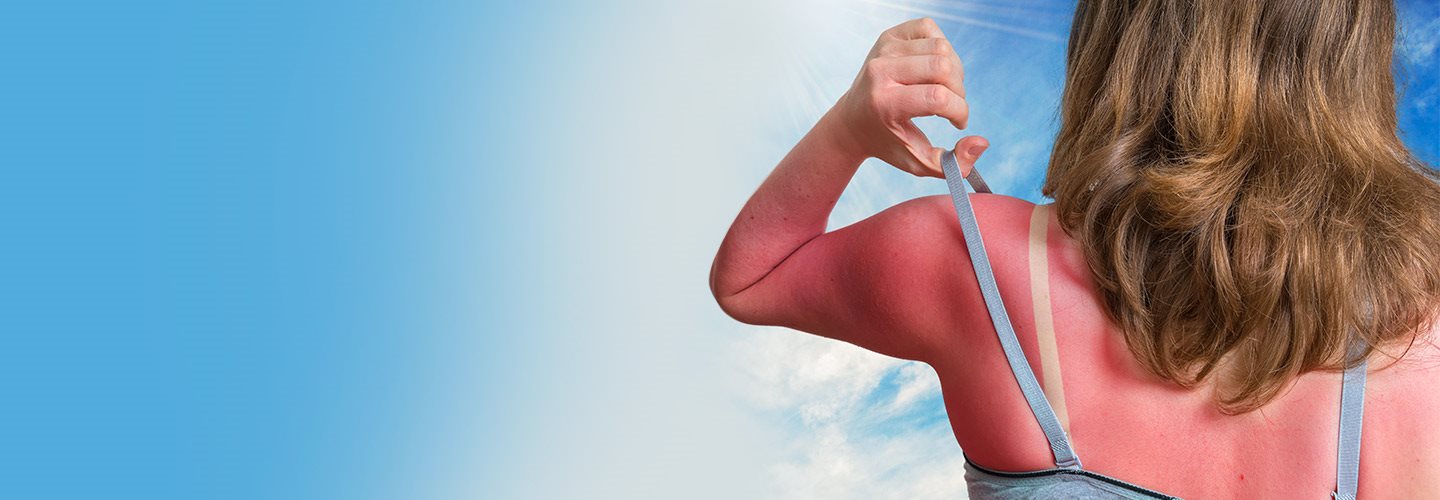 foto insolazione schiena