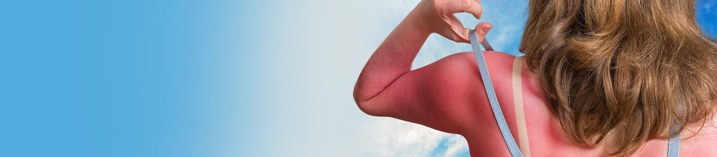 foto insolazione schiena