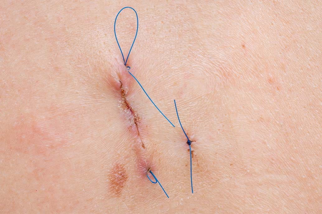 punti di sutura riassorbibili