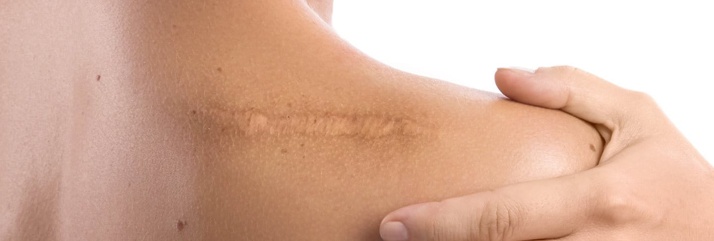 cicatrice post punti di sutura sulla spalla
