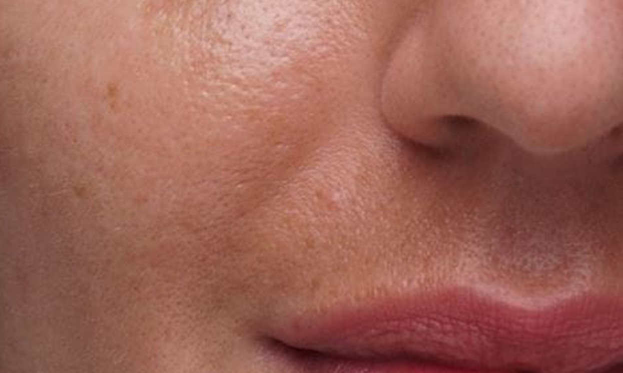 Melasma is a form of hyperpigmentation