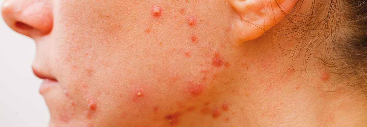 dobry krem na trądzik