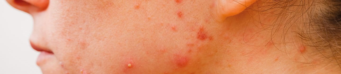 dobry krem na trądzik