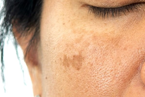 melasma przebarwienia na twarzy