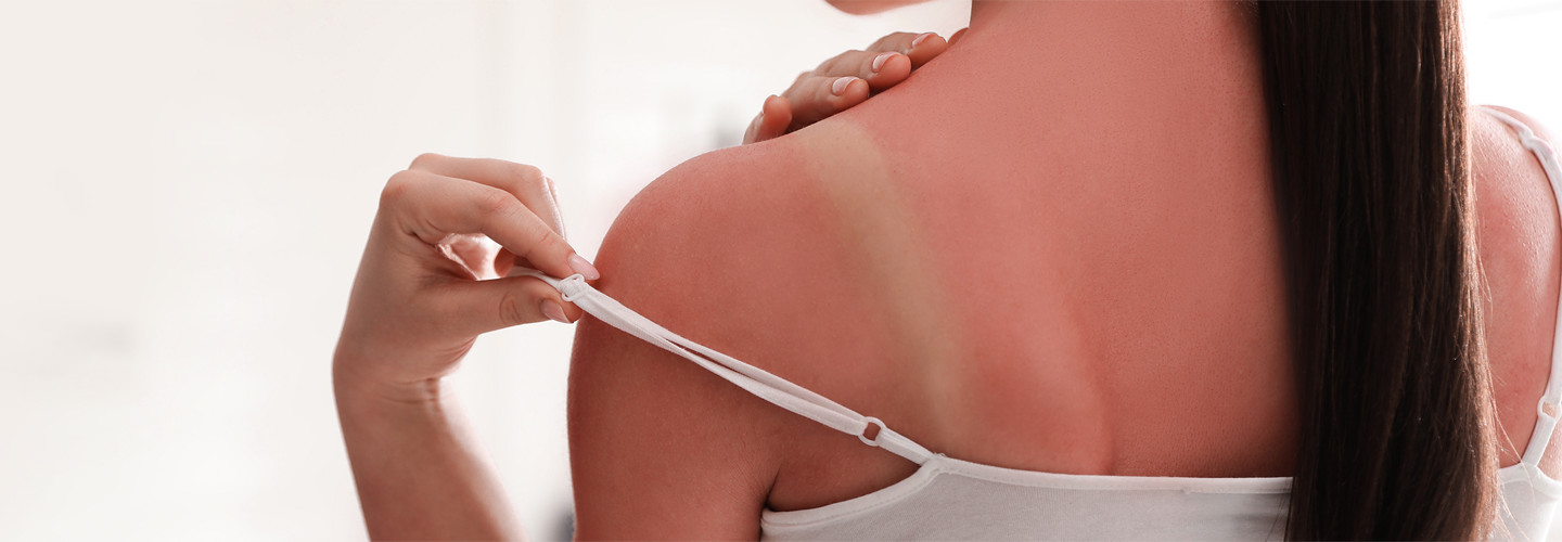 Oparzenia słoneczne - czym smarować