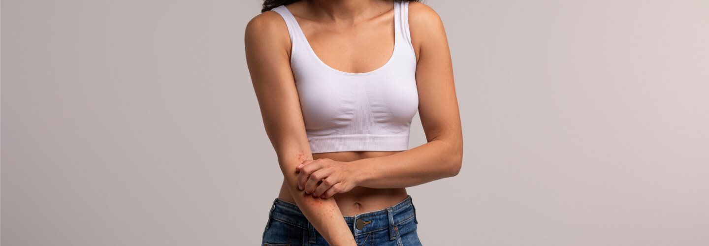 pokrzywka na skórze