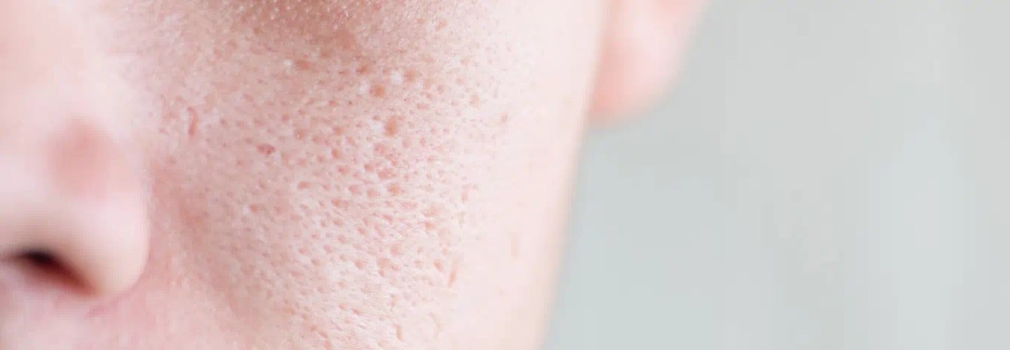 rozszerzone pory na twarzy