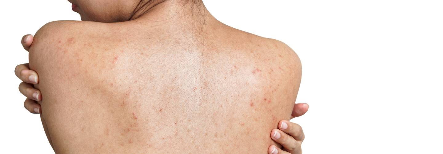 Trądzik na plecach