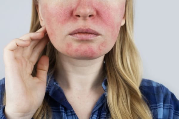 uczulenie na słońce