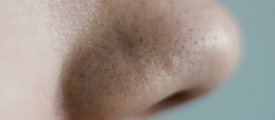 Wągry na nosie jak się pozbyć