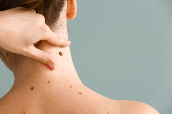 wizyta u dermatologa