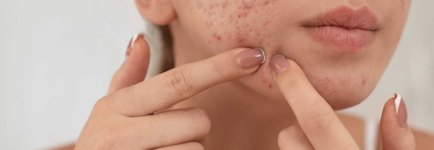 Czy wyciskanie pryszczy jest dobre