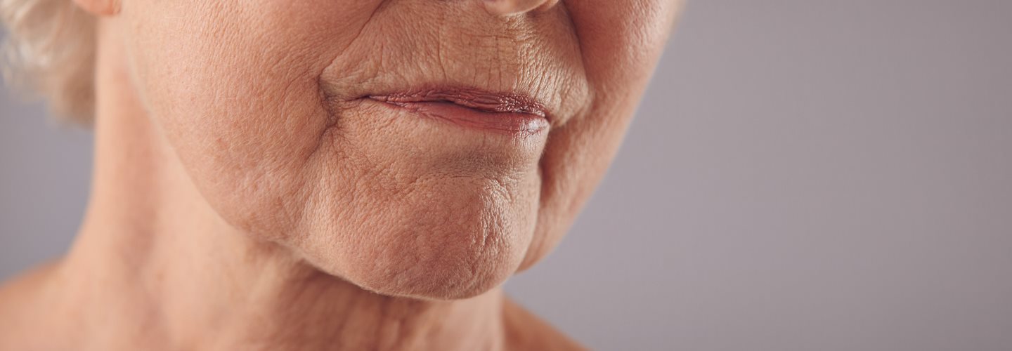 zmarszczki marionetki