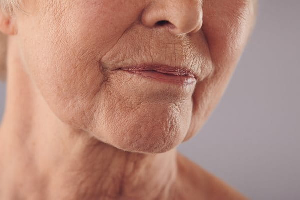 zmarszczki marionetki