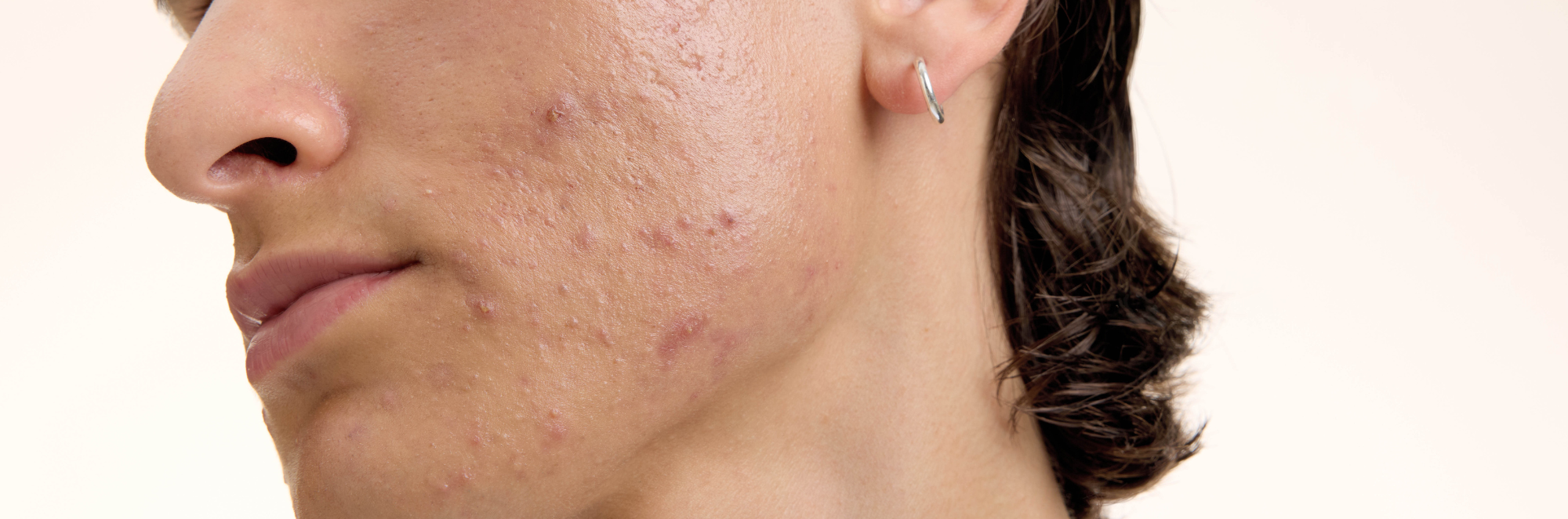 närbild av en mans haka med akne