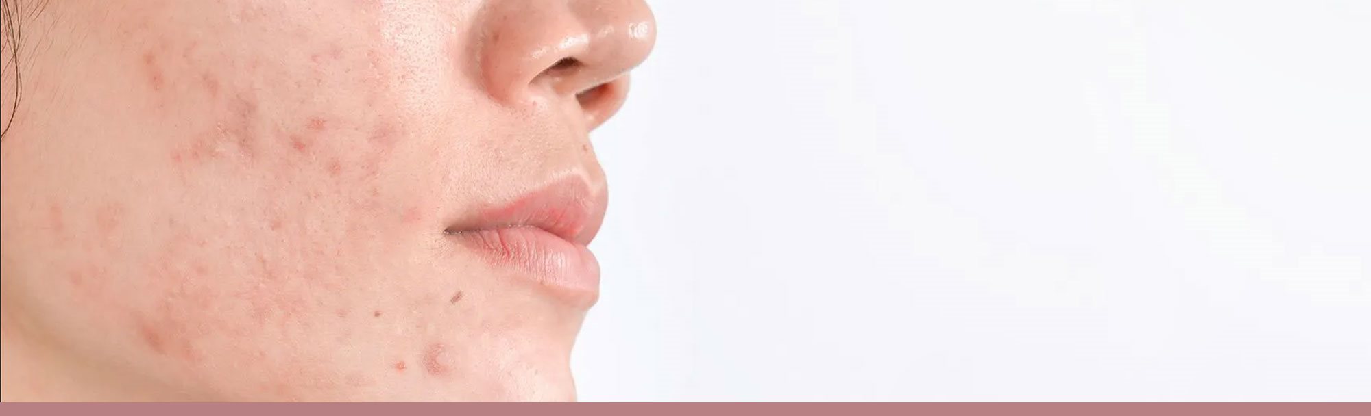 Przebarwienia pozapalne po trądziku