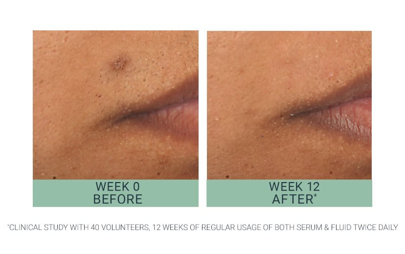 Clinically proven to visibly reduce post-acne marks by up to 80%<1>object</sup> and blemishes by up to 90%<sup>2</sup>. Visibly improves pores by up to 71%<sup>2</sup>.  First visible results in 2 weeks.       1, 2: Gallinger J. et al, Effective solution to reduce both blemishes and acne-related post-inflammatory hyperpigmentation with a novel skin care formulation tailored for acne-prone skin containing the tyrosinase inhibitor Thiamidol, EADV 2021.