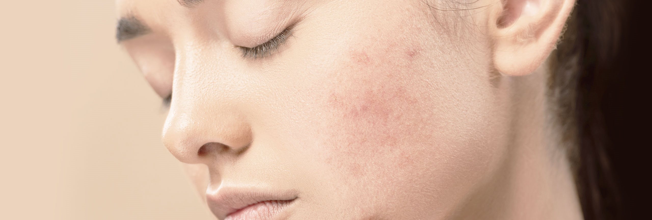 piel con una cicatriz hiperpigmentada