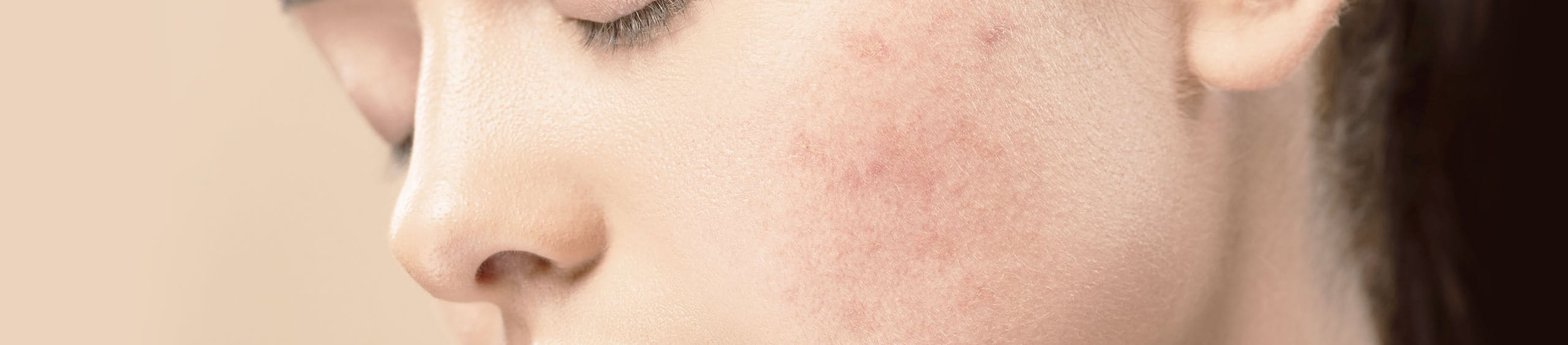 Piel con signos de hiperpigmentación