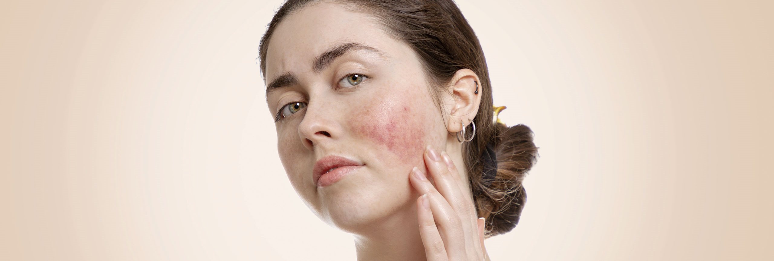 Piel del rostro afectada por rosácea