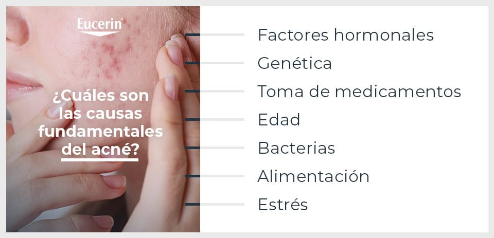 Principales factores que causan el acné.