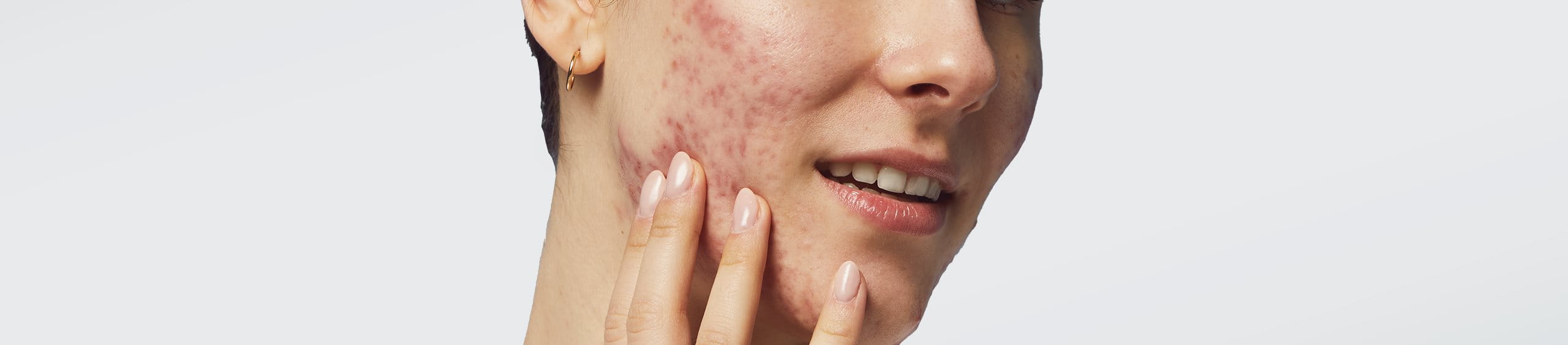 Factores fundamentales que causan el acné