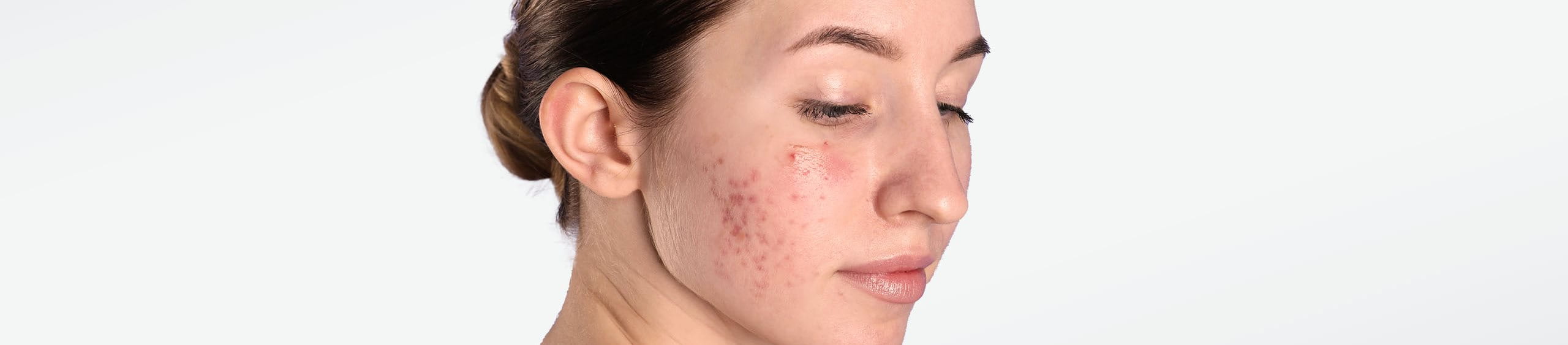 Mujer tratando el acné en su piel