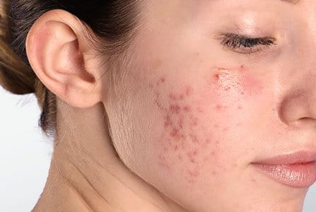 Mujer tratando el acné en su piel