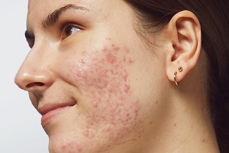 ¿Puede causar acné el estrés?