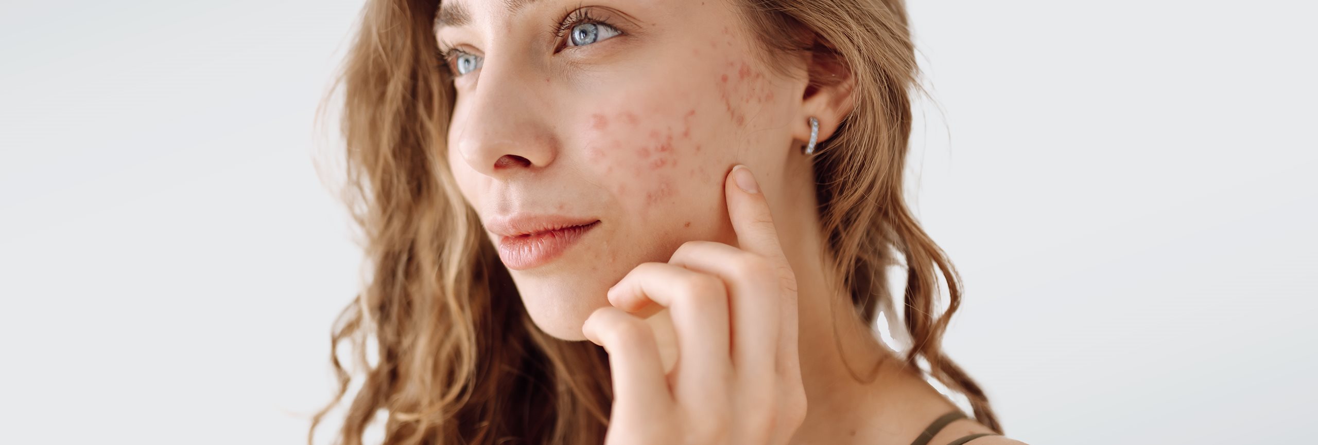 ¿El sol ayuda a reducir el acné?